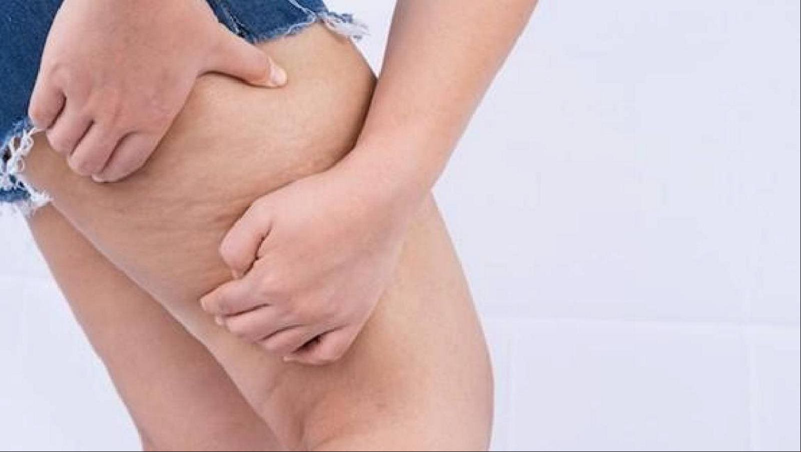 O lipedema é caracterizado pelo acúmulo de tecido adiposo nas pernas, quadris e braços e pode estar relacionado com as flutuações hormonais da mulher